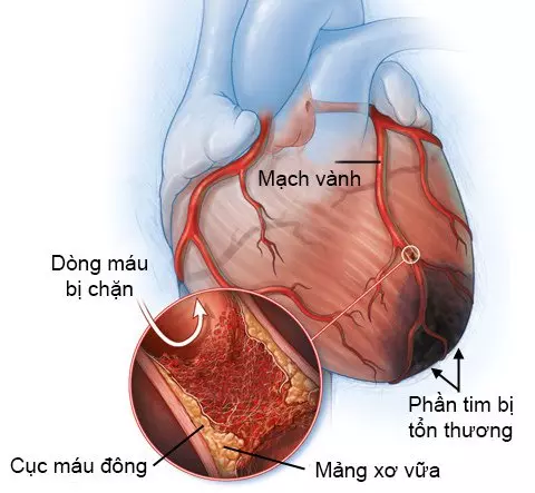 Bị thiếu máu tim, nhịp chậm, uống thuốc chưa đỡ phải làm gì?